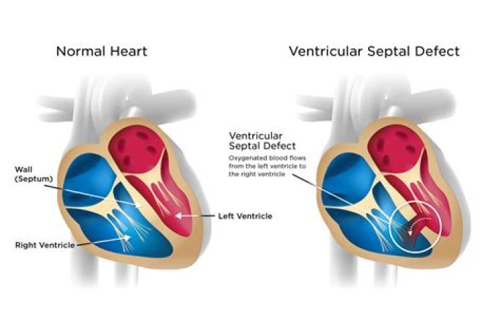 How long can a person live with atrial septal defect?
