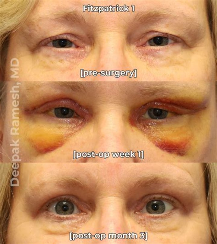 How long does it take to recover from entropion surgery?