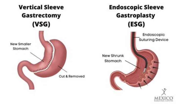 Is a gastric sleeve better than a gastric bypass?