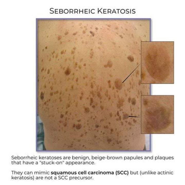 What is the cause of seborrheic keratosis?